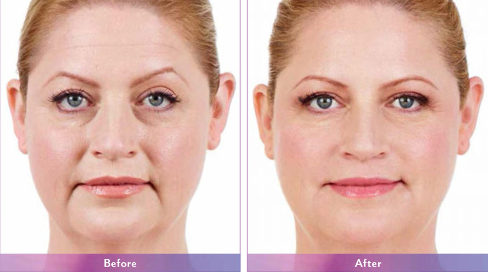 juvederm